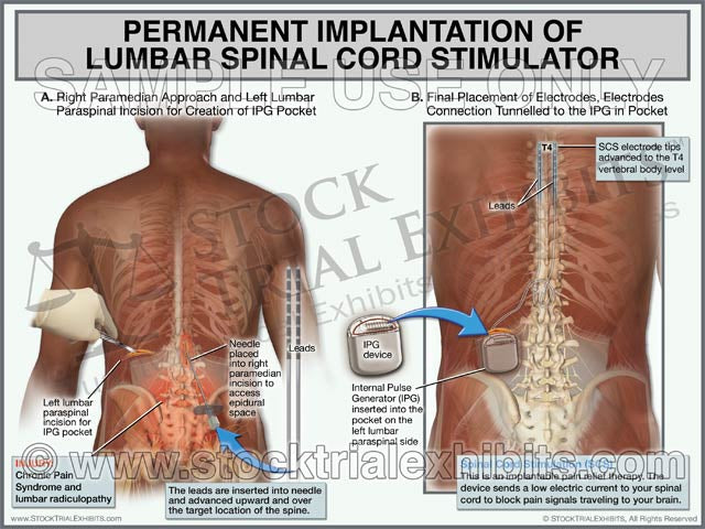 Trial exhibit, Diagram, medical illustrations of permanent implantation of spinal cord stimulator of the lumbar spine with anatomical labels. Medically accurate trial exhibit for demand letters, mediation or trial presentation.