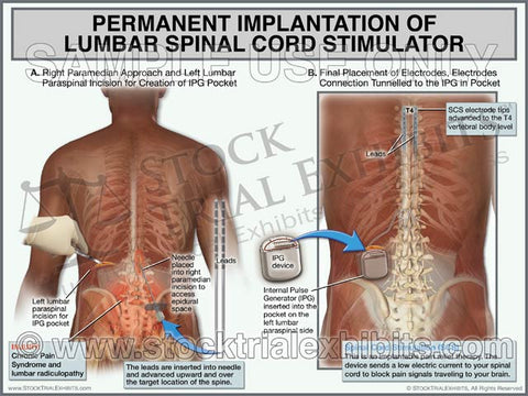 Lumbar Spinal Cord Stimulator, Permanent Implantation Procedure (Male, African American)