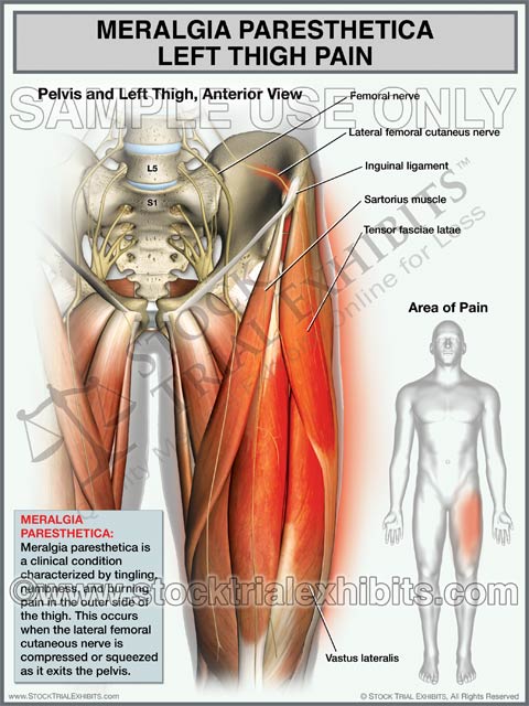 Meralgia Paresthetica trial exhibit shows orientation and location of Meralgia Paresthetica - Left Thigh Pain on a male figure. Exhibit includes enlarged close up view of left thigh anatomy with descriptive labels of anatomy and descriptive overview of Meralgia paresthetica condition, available for purchase and immediate digital download. Meralgia Paresthetica stock trial exhibit