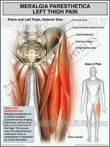 Meralgia Paresthetica - Left Thigh Pain (Male)