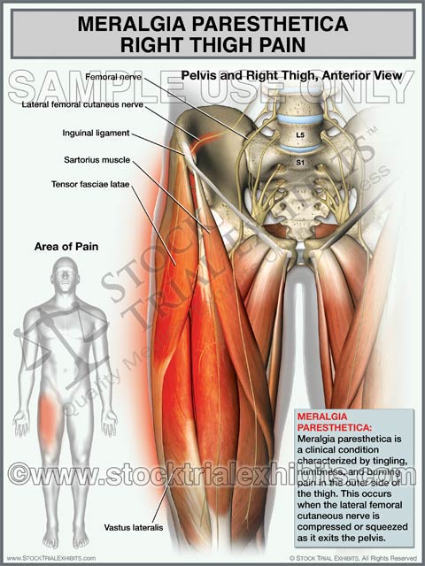  Meralgia Paresthetica trial exhibit shows orientation and location of Meralgia Paresthetica - Right Thigh Pain on a male figure. Exhibit includes enlarged close up view of right thigh anatomy with descriptive labels of anatomy and descriptive overview of Meralgia paresthetica condition, available for purchase and immediate digital download. Meralgia Paresthetica trial exhibit