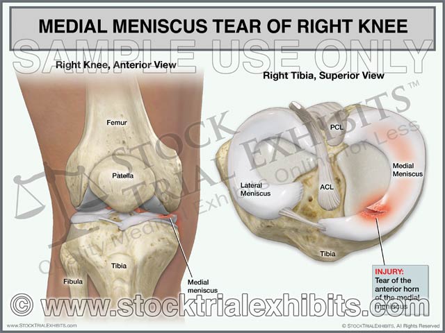 Medial Meniscus Tear Anterior Horn of Right Knee – Stock Trial Exhibits