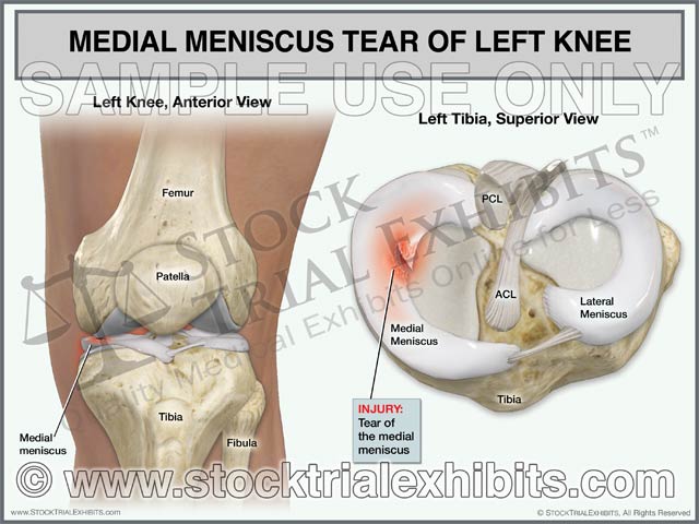 Meniscus Rupture Medial Meniscus Tear of Left Knee – Stock Trial Exhibits
