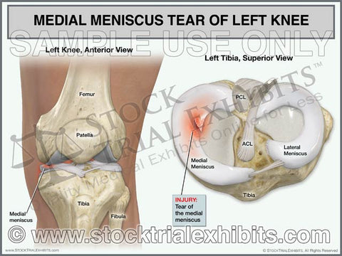 Medial Meniscus Tear of Left Knee