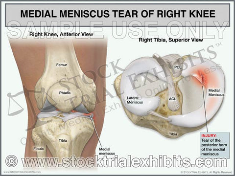 Medial Meniscus Tear Posterior Horn of Right Knee