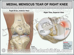 Medial meniscus tear of the posterior horn, of the right knee. Trial exhibit. Anterior view of right knee is shown for orientation of anatomy and location of injury. A superior view of the tibia is also shown, with an enlarged view that graphically depicts the medial meniscus tear of the posterior horn. Both views of the knee are shown with descriptive labels of knee anatomy, and superior view contains posterior horn of medial meniscus injury label. Stock Trial Exhibit medial meniscus tear.