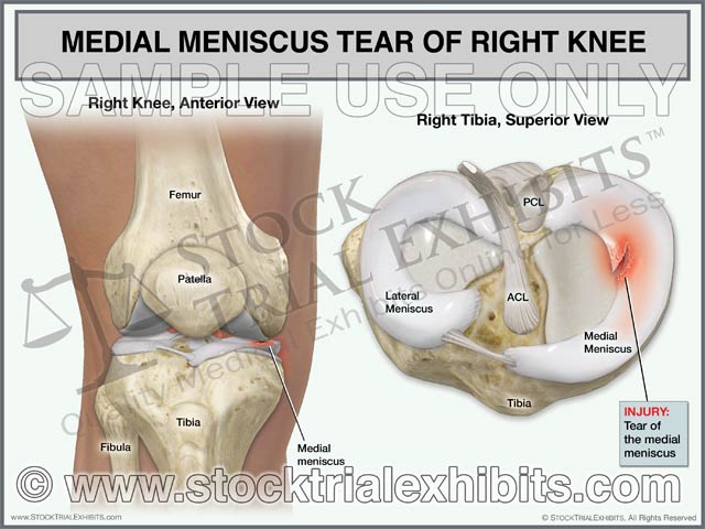 This trial exhibit depicts a right knee with a medial meniscus tear. Anterior view of right knee is shown for orientation of anatomy and location of injury. A superior view of the tibia is also shown, enlarged view that graphically depicts the medial meniscus tear. Both views of the knee are shown with descriptive labels of knee anatomy and medial meniscus injury.