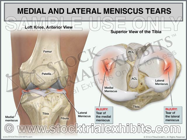 This trial exhibit depicts a left knee with medial and lateral meniscus tears. Anterior view of left knee is shown for orientation of anatomy and location of injuries. A superior view of the tibia is also shown, enlarged view that graphically depicts the medial and lateral meniscus injuries. Both views of the knee are shown with descriptive labels of knee anatomy and medial meniscus injuries.