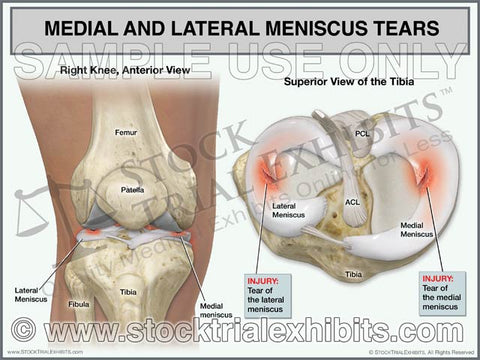 Medial and Lateral Meniscus Tears of Right Knee