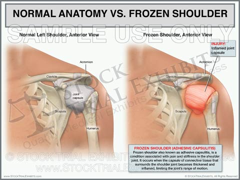 Normal Shoulder vs. Left Frozen Shoulder