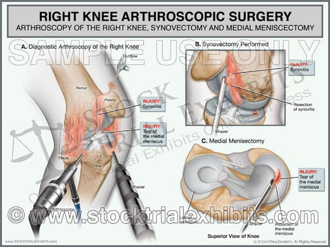 Right Knee Arthroscopic Surgery Synovectomy and Medial Meniscectomy