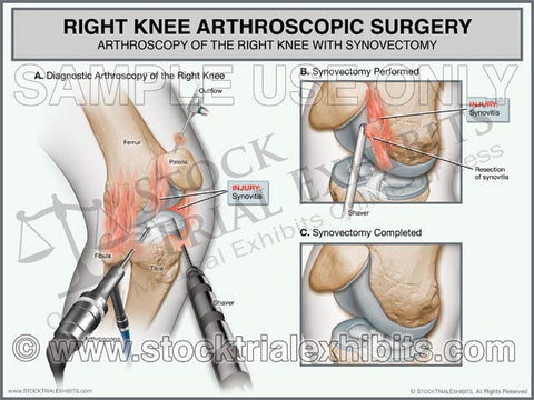 Right Knee Arthroscopic Surgery Synovectomy