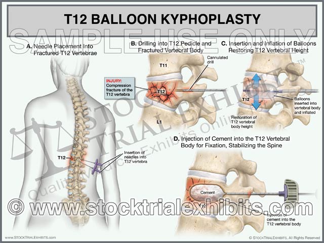 This trial exhibit graphically depicts a balloon kyphoplasty surgical procedure on a female patient. This exhibit shows orientation of T12 compression fracture injury, insertion of needles, drilling of fractured vertebral body. Next two balloons are inserted and inflated to restore vertebral height, and cement is then injected into the vertebral body of T12 to complete the fracture fixation and stabilize the spine. 