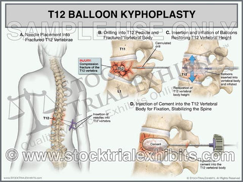 T12 Balloon Kyphoplasty Procedure - Female