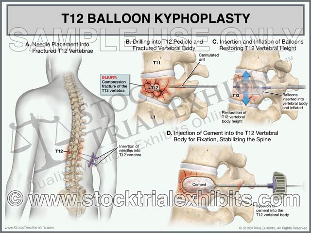 Lumbar Spine L1 Compression Fracture Trial Exhibit – Stock Trial