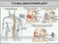 This trial exhibit graphically depicts a balloon kyphoplasty surgical procedure on a male patient. This exhibit shows orientation of T12 compression fracture injury, insertion of needles, drilling of fractured vertebral body. Next two balloons are inserted and inflated to restore vertebral height, and cement is then injected into the vertebral body of T12 to complete the fracture fixation and stabilize the spine. 