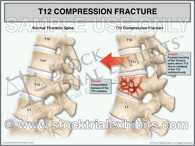 This trial exhibit depicts T12 compression fracture injury of the thoracic spine, compared to a normal thoracic spine shown in the lateral view. Clear descriptive labels of anatomy and fracture injury of the thoracic spine highlighting the injury, and contrasting it to the normal anatomy. 