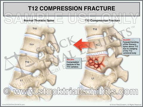 T12 Compression Fracture Compared to Normal Thoracic Spine