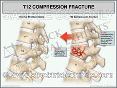 This trial exhibit depicts T12 compression fracture injury of the thoracic spine, compared to a normal thoracic spine shown in the lateral view. Clear descriptive labels of anatomy and fracture injury of the thoracic spine highlighting the injury, and contrasting it to the normal anatomy. 