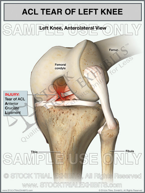 ACL tear stock medical illustration trial exhibit, stock medical illustration, ACL tear trial exhibit, trial exhibit of ACL tear, ACL tear medical illustration