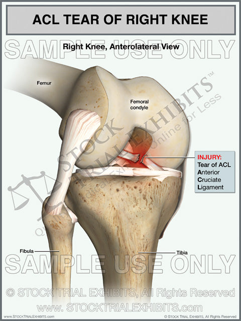 ACL tear right knee stock medical illustration trial exhibit