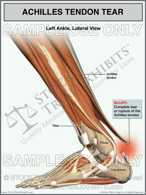 Achilles Tendon Tear of Left Ankle Stock Medical Illustration