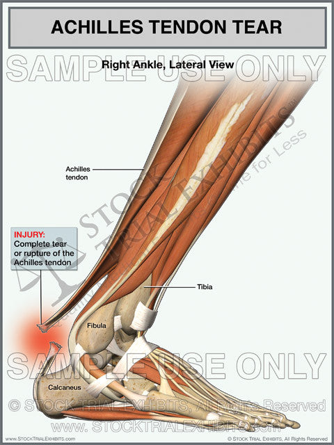 Achilles tendon tear Stock medical illustration