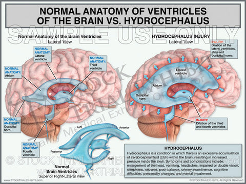 Brain Ventricles Anatomy vs. Hydrocephalus