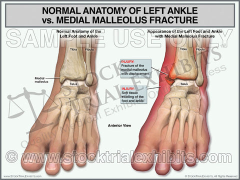 Ankle Anatomy Normal vs Medial Malleolus Fracture of Left Ankle