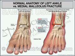 Normal anatomy of the left ankle compared to medial malleolus fracture, medial malleolus fracture vs normal anatomy of ankle, normal anatomy of ankle vs. medial malleolus fracture