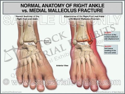 Ankle Anatomy Normal vs Medial Malleolus Fracture of Right Ankle