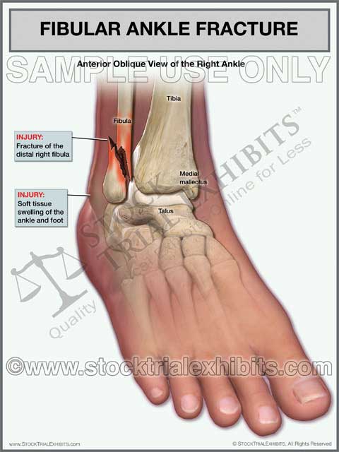 This trial exhibit graphically depicts a fibular fracture of the right ankle, with displacement and swelling of the right ankle and foot. A fibular fracture injury involves the fibula or lateral malleolus of the ankle. This exhibit shows the fracture of the fibula in the anterior oblique view, with descriptive labels of the anatomy and injury.
