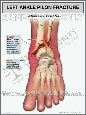 Ankle Fracture - Pilon Fracture of the Left Ankle