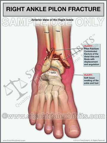 Ankle Fracture - Pilon Fracture of the Right Ankle