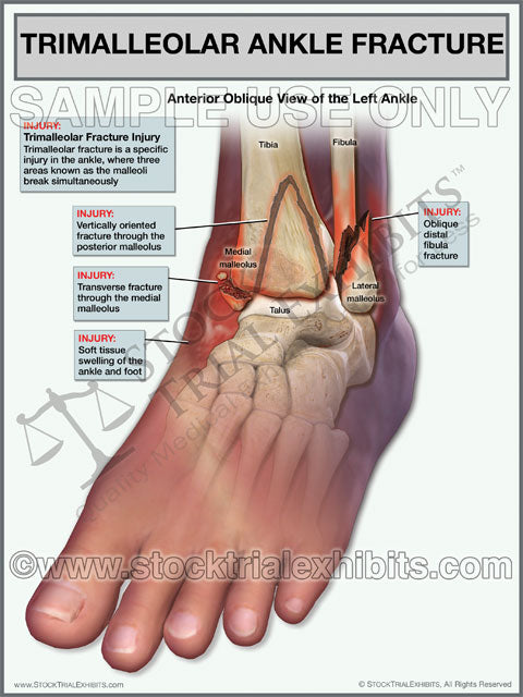 Ankle Fracture - Trimalleolar Fracture of the Left Ankle, Ankle fracture medical illustration, ankle fracture trimalleolar injury medical exhibit, trimalleolar fracture of left ankle, trimalleolar fracture medical illustrations