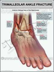 Ankle Fracture - Trimalleolar Fracture of the Right Ankle, fracture of right ankle, trimalleolar right fracture, right ankle trimalleolar fracture, right ankle fracture, right ankle injury medical illustration, ankle fracture medical legal exhibit, 