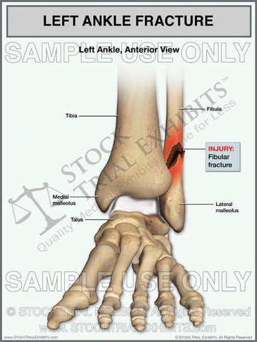 Ankle Fracture of the Left Fibula Trial Exhibit
