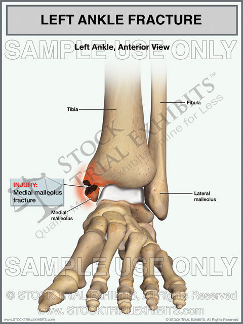medial malleolus fracture of the left ankle stock medical illustration