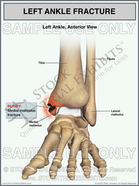 Maleulus Left Medial Malleolus Ankle Fracture Trial Exhibit | Stock Trial Exhibits