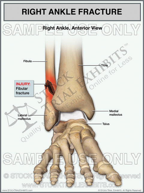 fibular fracture of the right ankle stock medical illustration