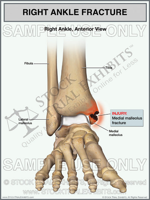 medial malleolus fracture of the right ankle stock medical illustration