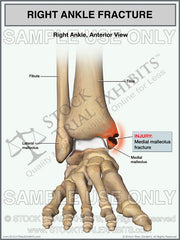 Medial Malleolus Fracture of the Right Ankle Trial Exhibit — anterior view with anatomical labels. Stock medical illustration for personal injury attorneys. Instant Download.