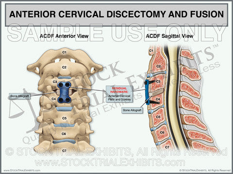 ACDF Anterior Cervical Discectomy and Fusion. This trial exhibit depicts postoperative view of an ACDF procedure - anterior cervical discectomy and fusion, shown in the both anterior and sagittal views with descriptive labels of anatomy and residual hardware. 