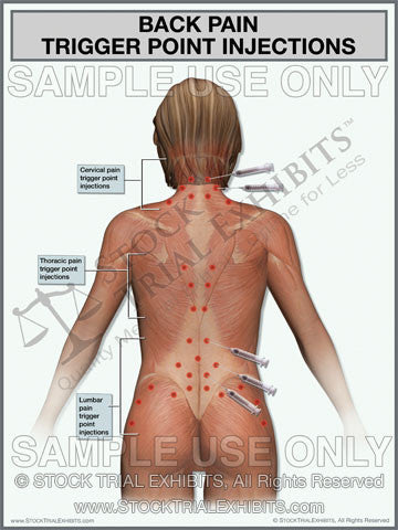 trigger point injections for back pain management of the cervical, thoracic and lumbar spine 