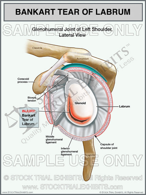 Bankart Tear of Labrum Injury left shoulder stock medical illustration