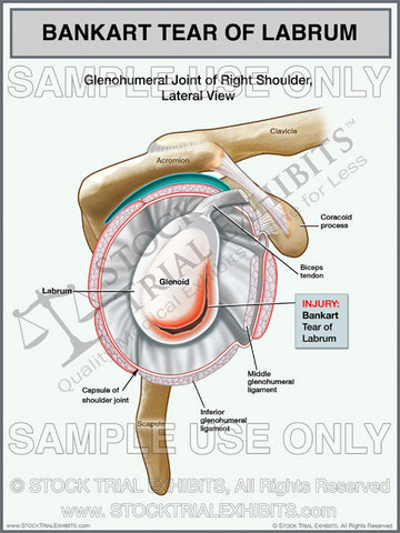 Bankart Tear Labrum Injury of the Right Shoulder