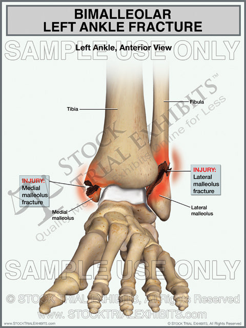 Bimalleolar ankle fracture stock medical illustration trial exhibit