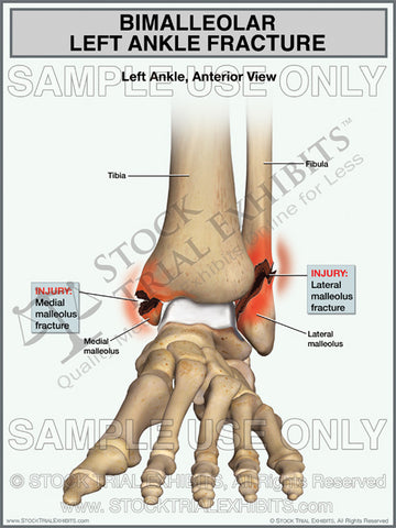 Bimalleolar Left Ankle Fracture
