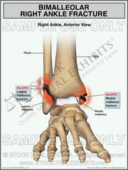 Bimalleolar Right Ankle Fracture Trial Exhibit — medial & lateral malleolus fractures in anterior view. Stock medical illustration for personal injury attorneys. Instant Download.
