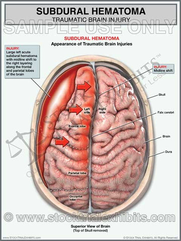 Brain Injury Subdural Hematoma (Left Side)